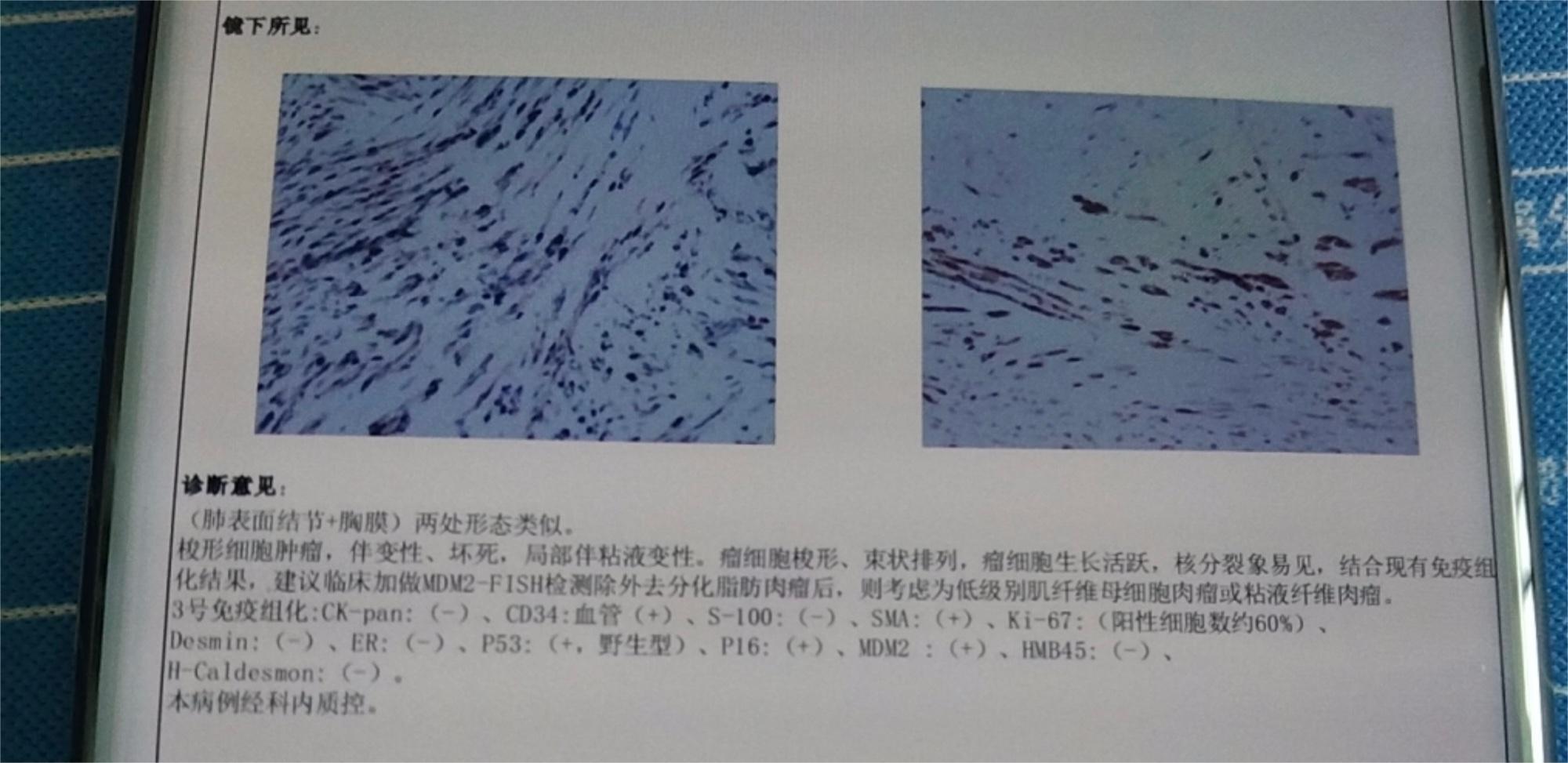 跪求网友这几种肺部肿瘤很罕见有没有好的治疗方法很着急